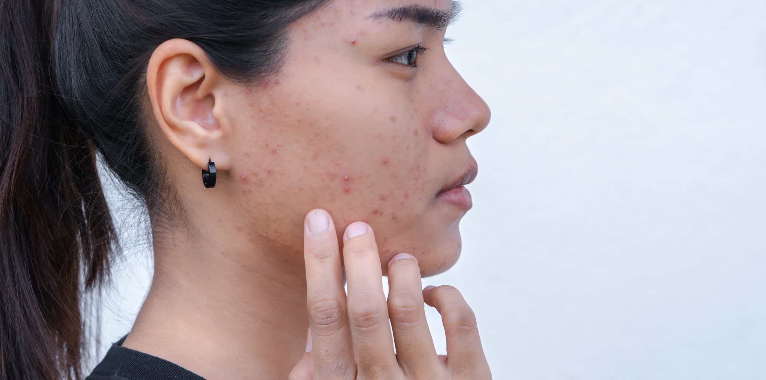 Hormonal Acne in Women: Causes and Treatment