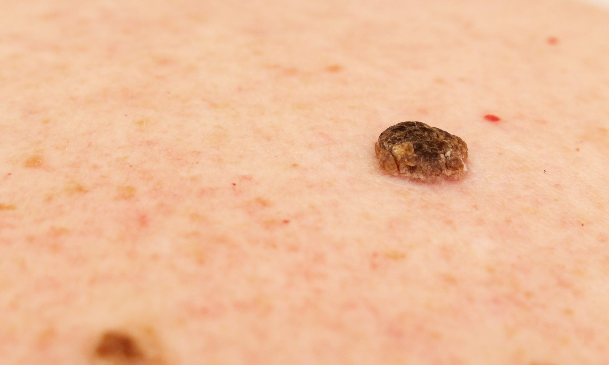 Seborrheic Keratosis FAQ