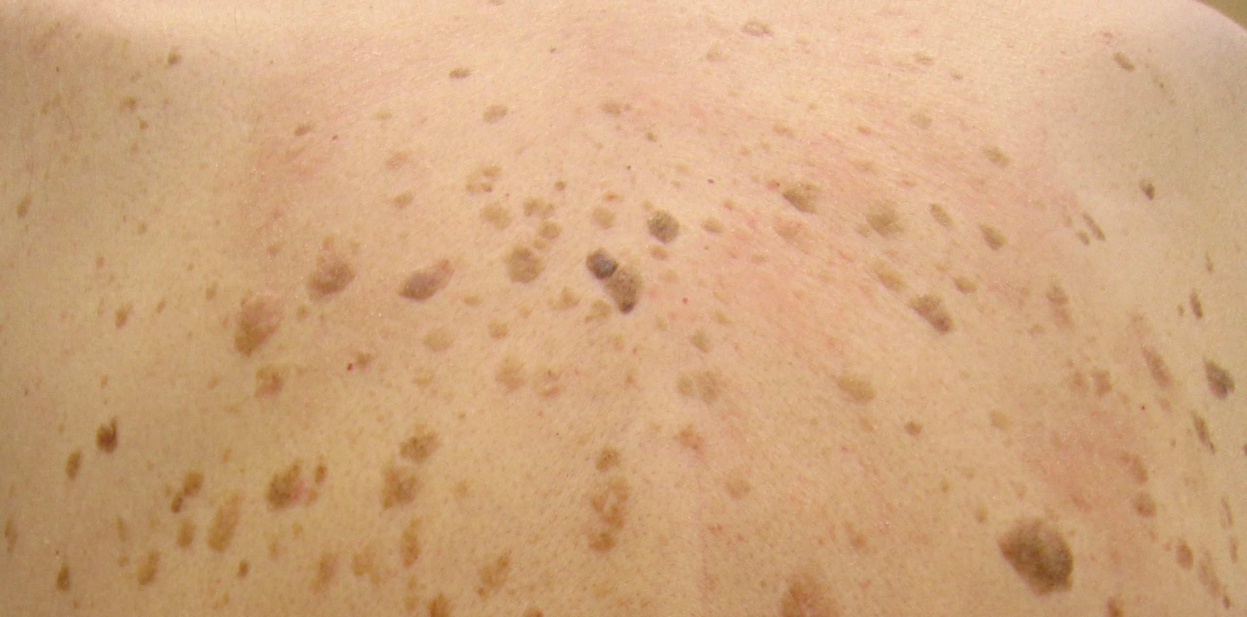 Seborrheic Keratosis Faq Vista Dermatology Free Download Nude Photo Gallery