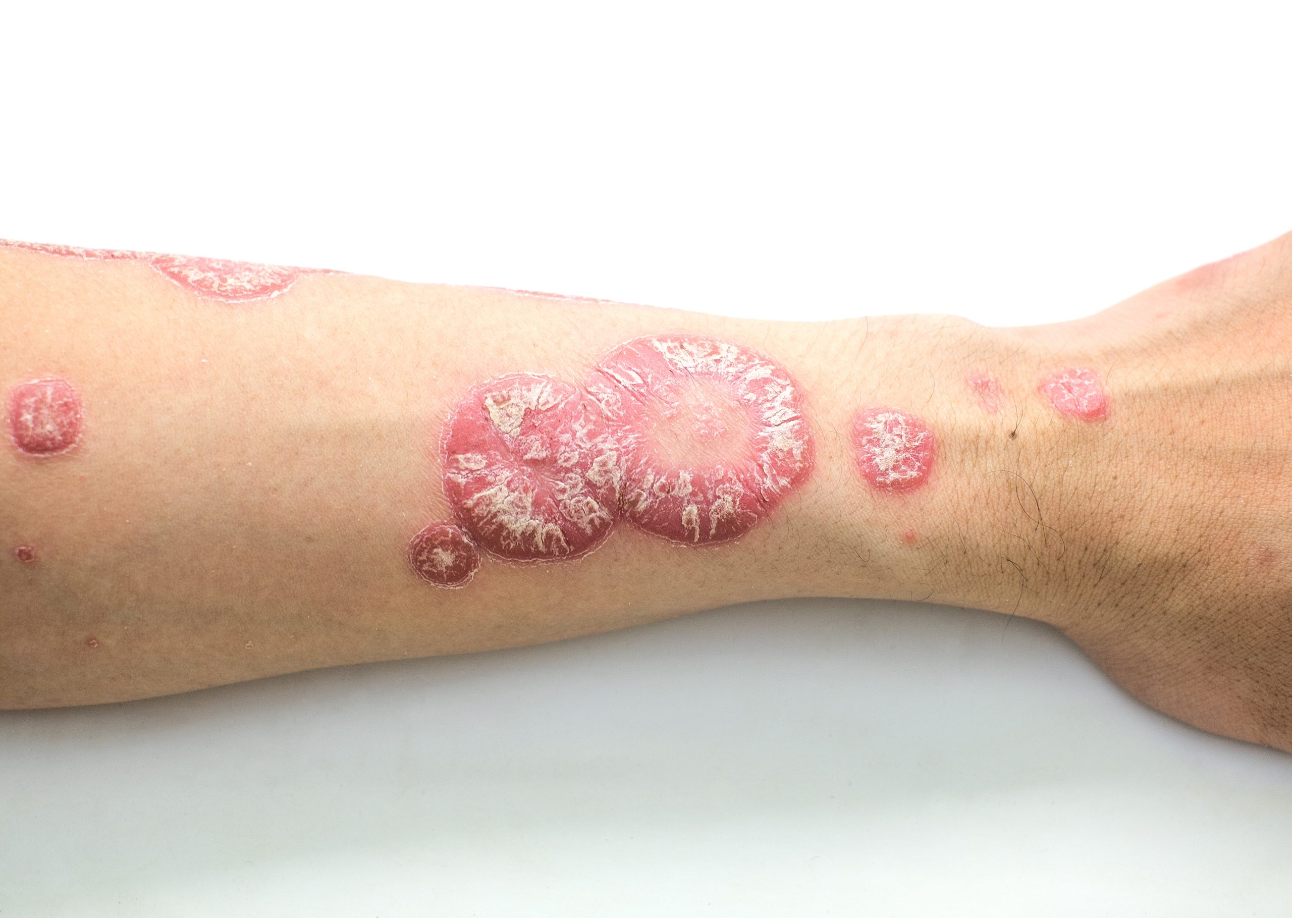 Facts About Psoriasis