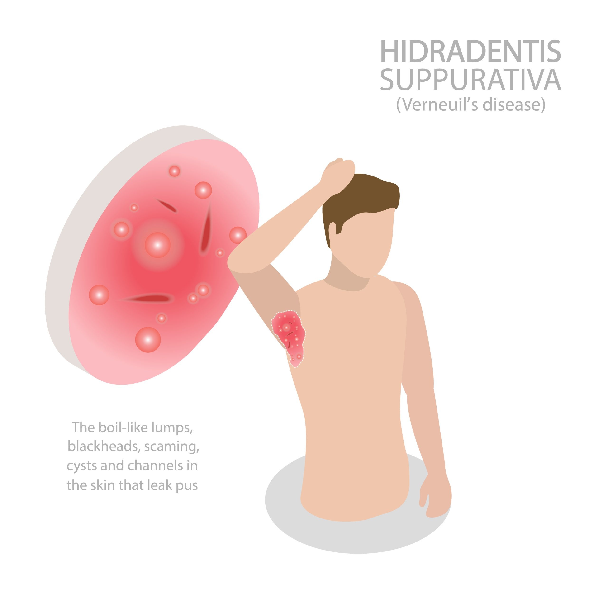 Hidradenitis Suppurativa FAQ