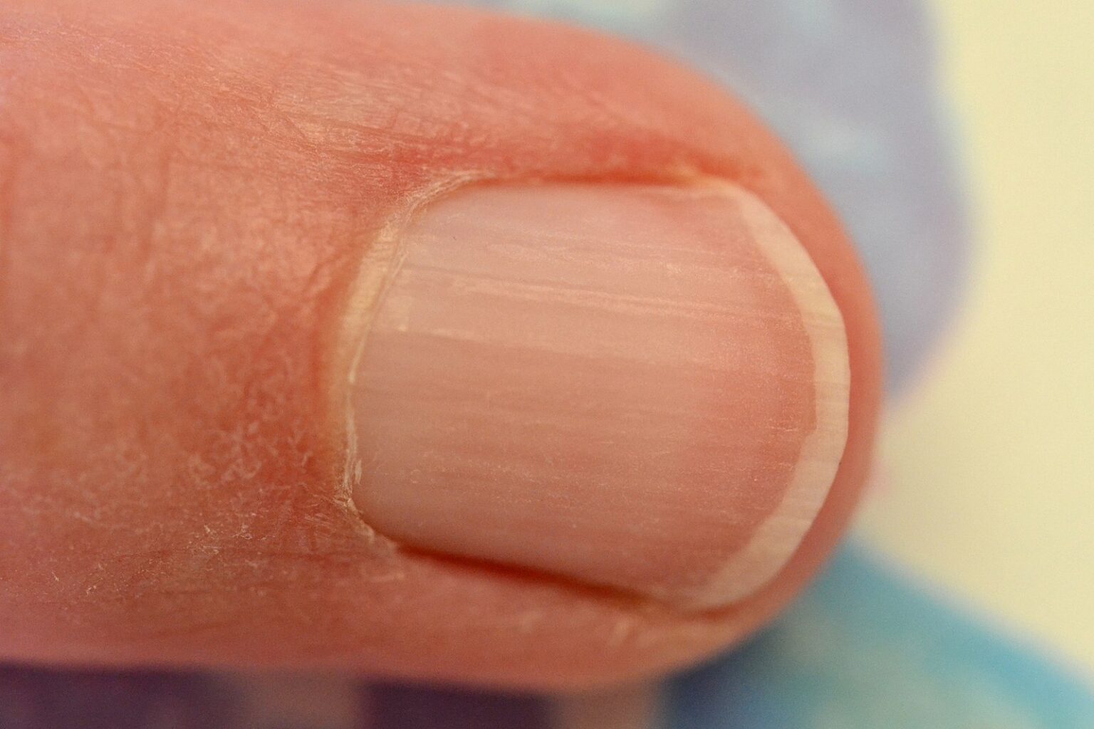 What can your fingernails tell you about your health? Vista Dermatology