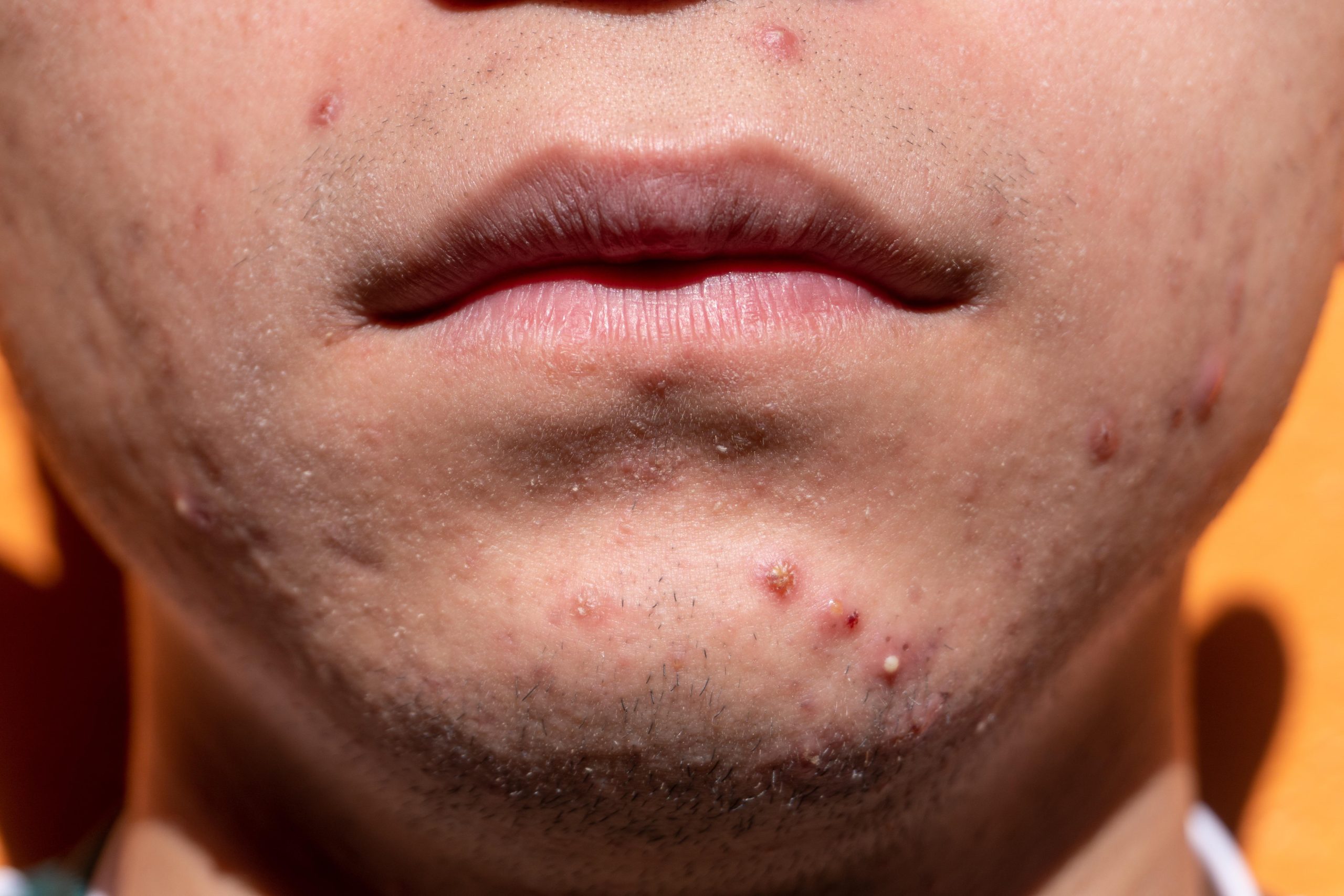 Types of Acne and Treatment