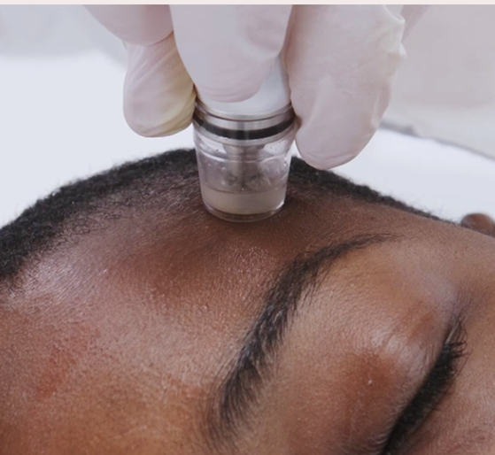 Microdermabrasion and Chemical Peels: Which One Is Right For You?